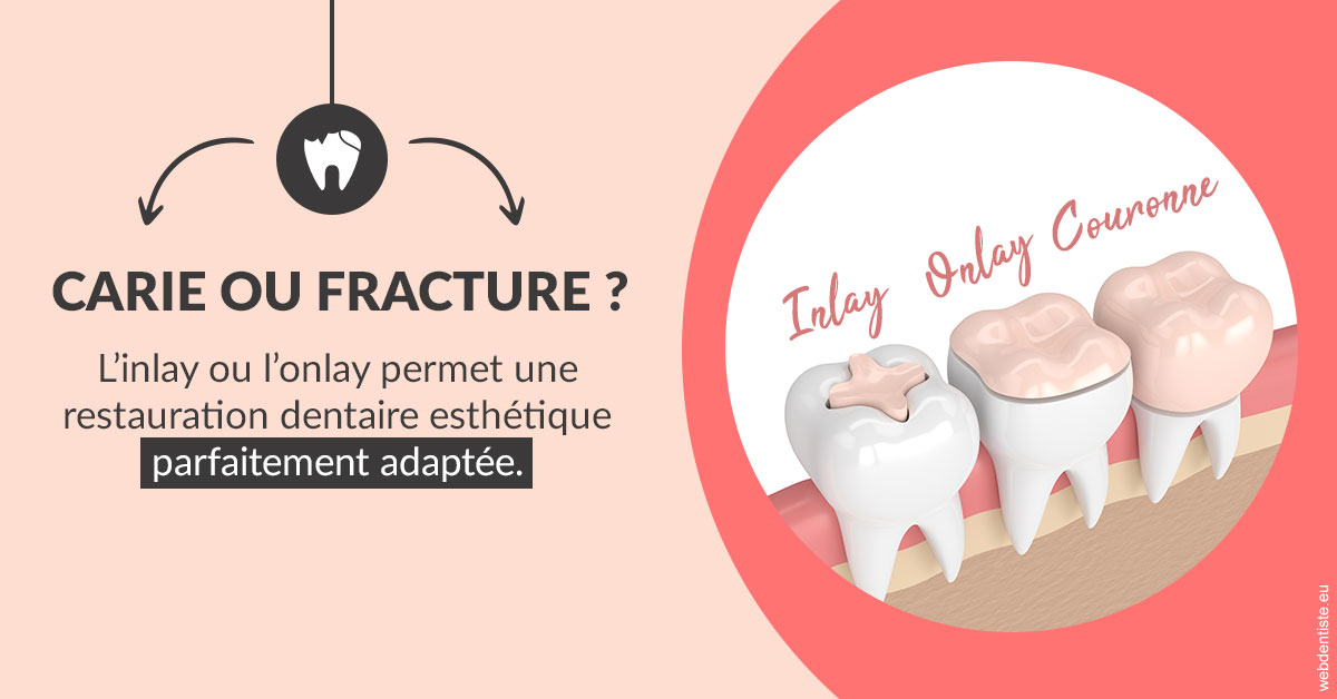 https://scp-chirurgien-dentiste-anais-freckhaus.chirurgiens-dentistes.fr/T2 2023 - Carie ou fracture 2