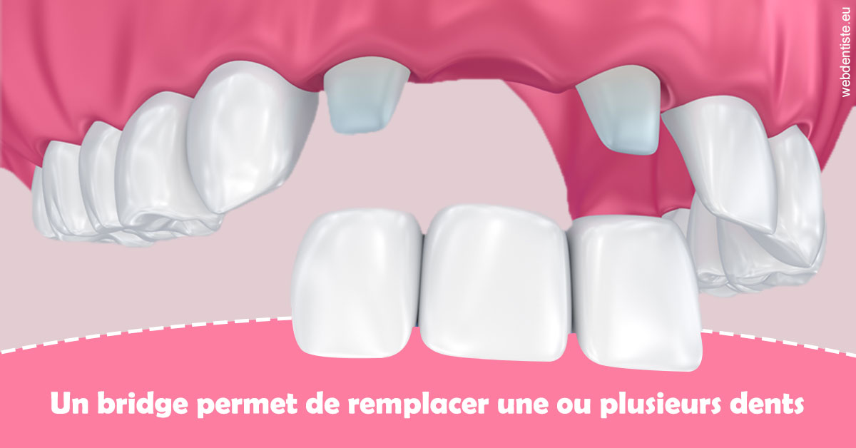 https://scp-chirurgien-dentiste-anais-freckhaus.chirurgiens-dentistes.fr/Bridge remplacer dents 2